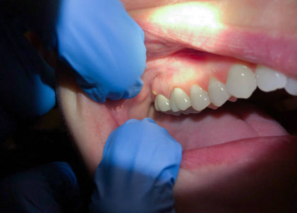 Best Emergency Wisdom Tooth Extraction in Las Animas, CO